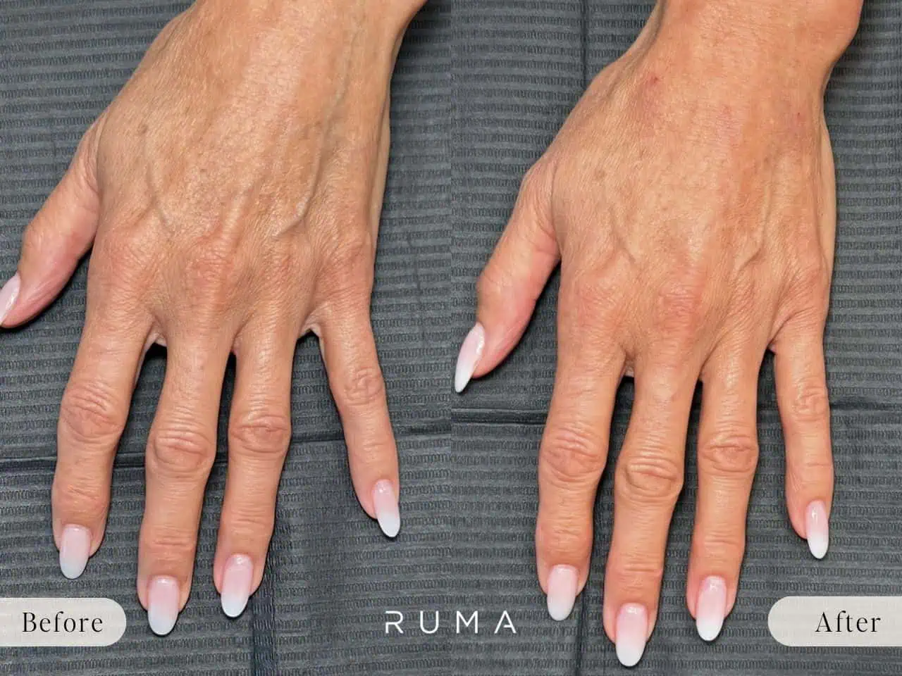 Restore Youthful Hands with Hand Filler: Benefits & What to Expect