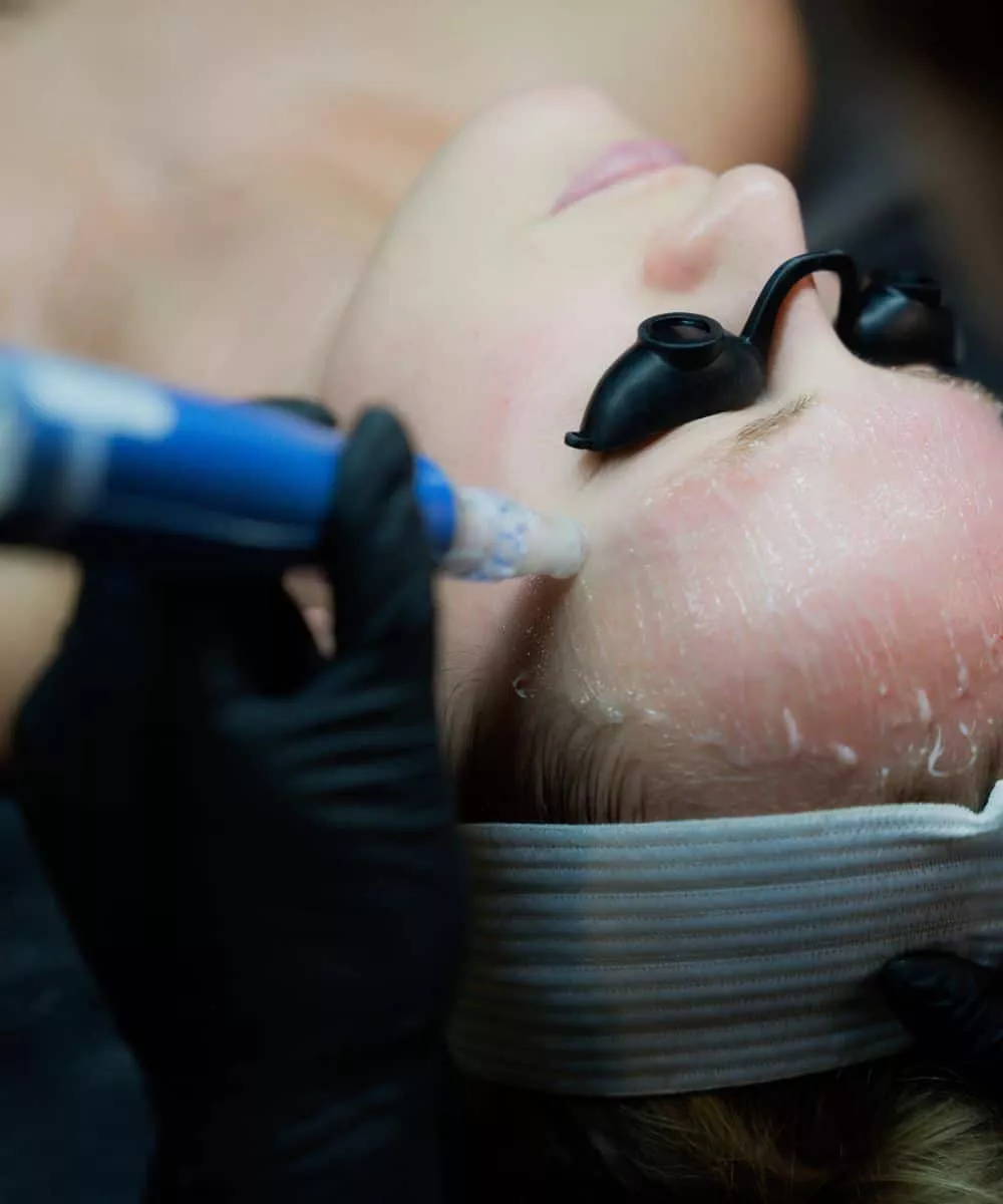 Microneedling