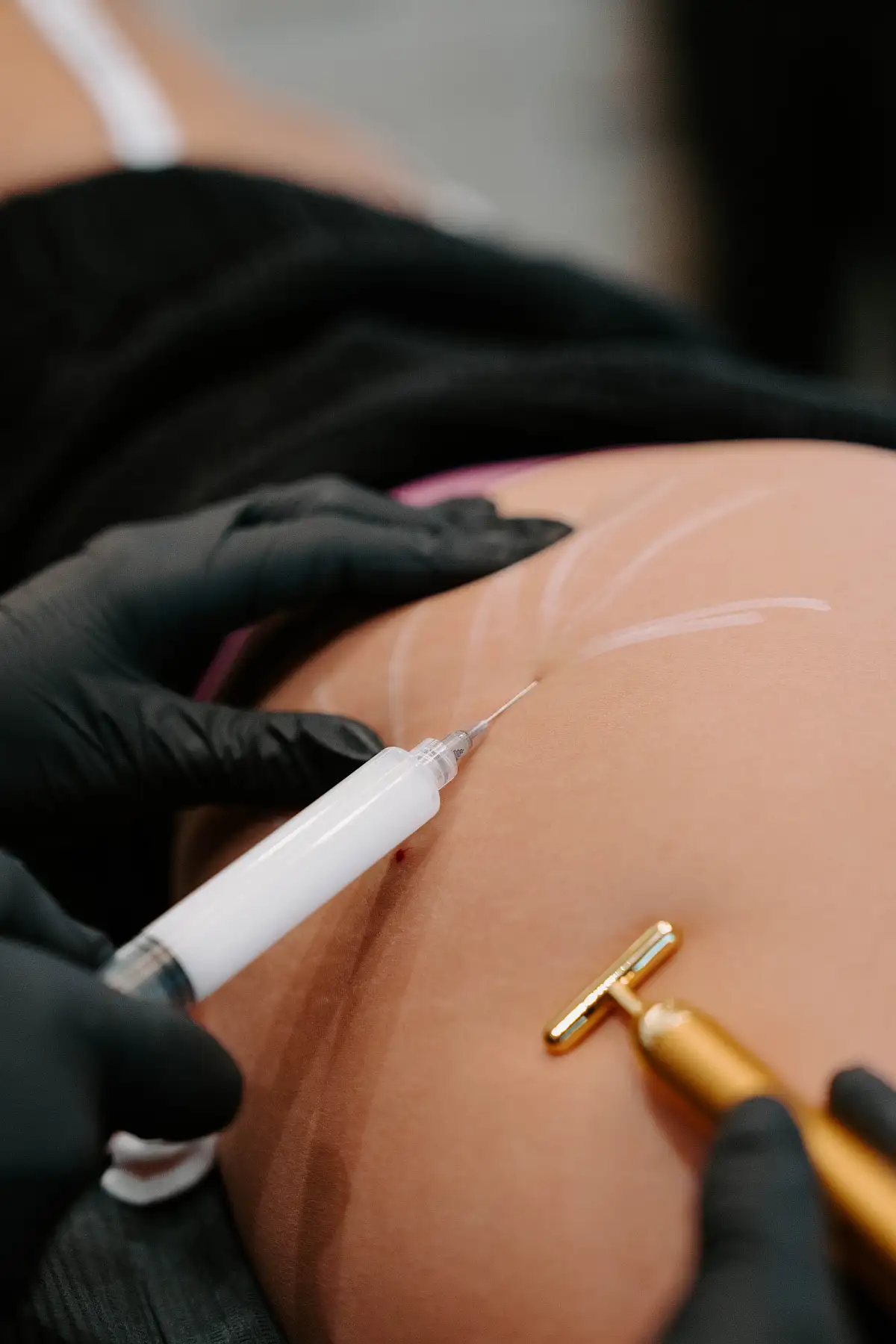 Sculptra & Radiesse