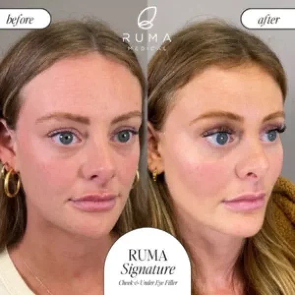 Fillers-BeforeandAfter-Ruma-1