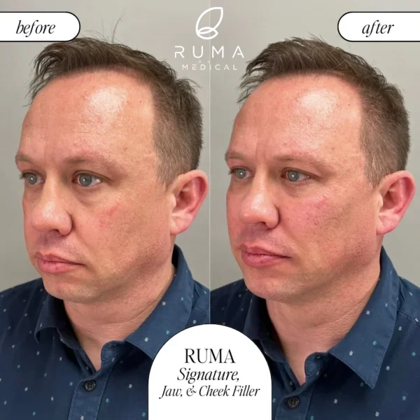 Fillers-BeforeandAfter-Ruma