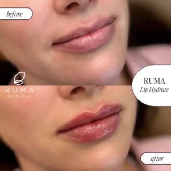 Fillers-BeforeandAfter-Ruma3