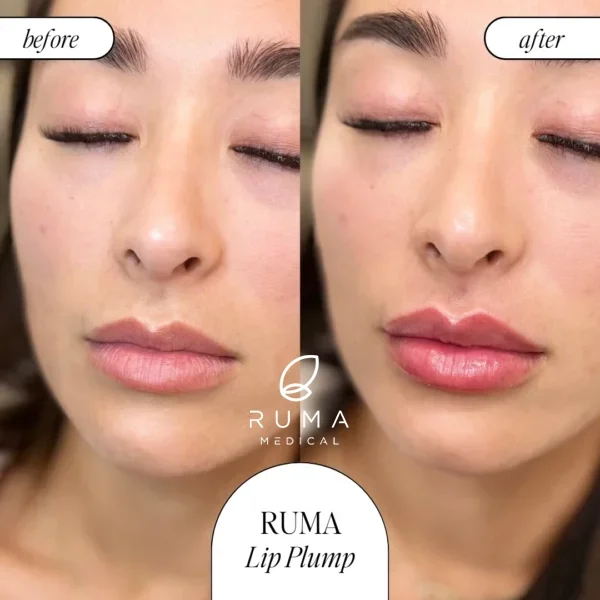 Fillers-BeforeandAfter-Ruma4