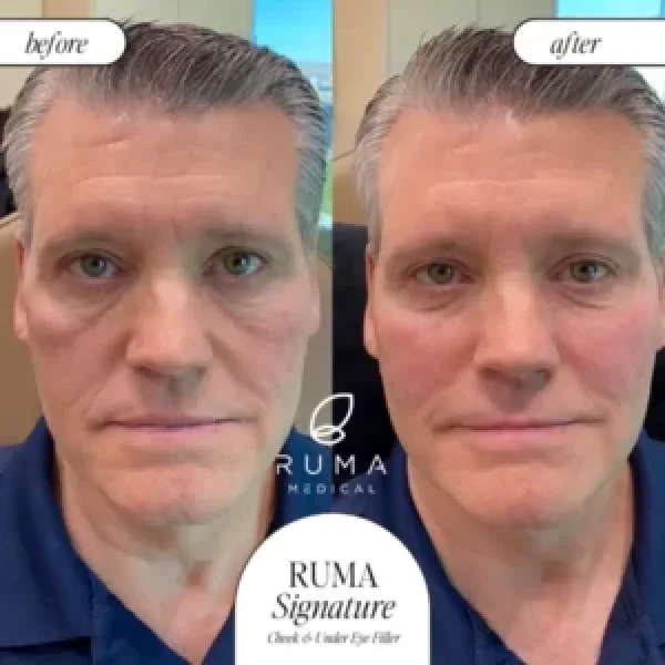 Fillers-BeforeandAfter-Ruma5