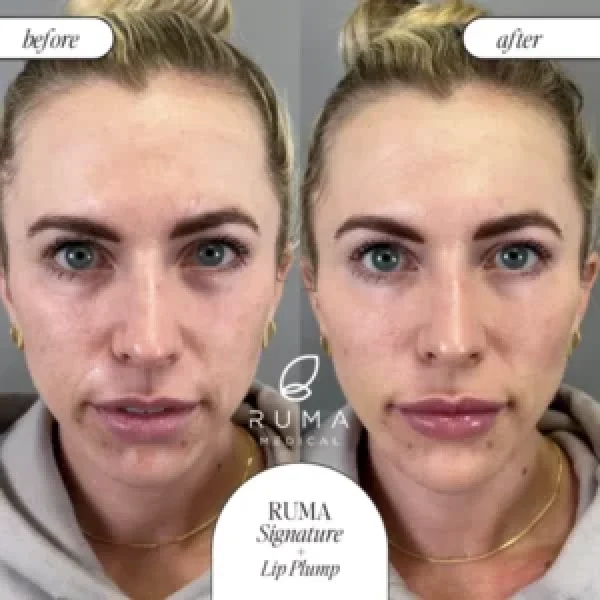 Fillers-BeforeandAfter-Ruma6