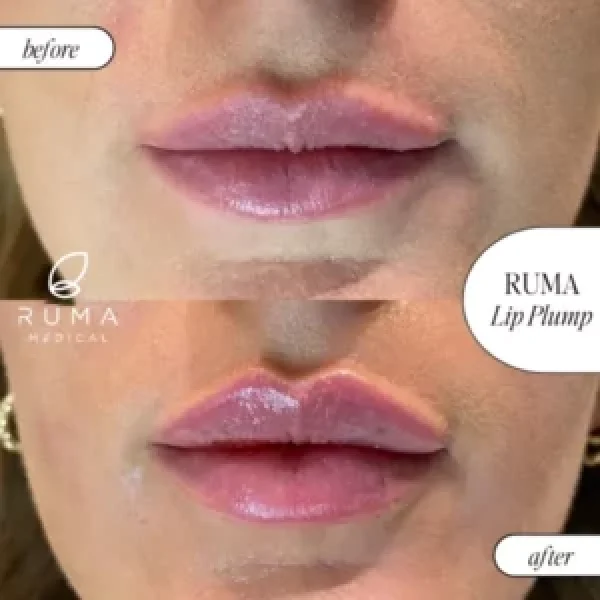 Fillers-BeforeandAfter-Ruma7