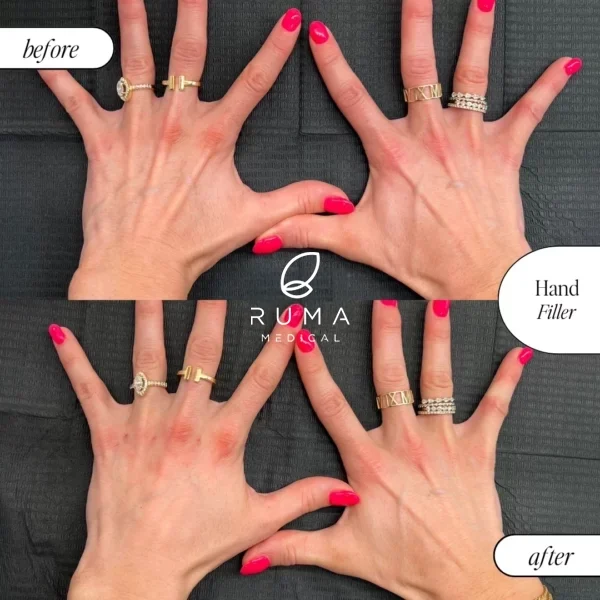 Fillers-BeforeandAfter-Ruma8